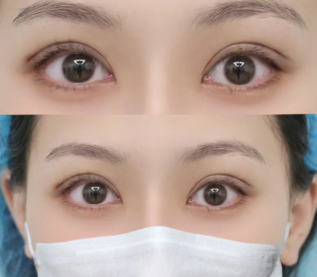 开大眼角