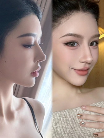 无辜眼综合,幼态脸